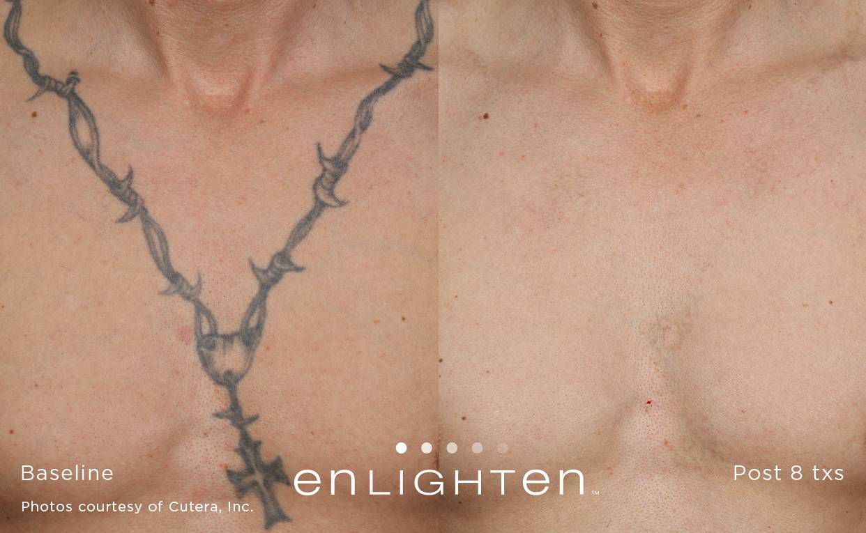 Tattoo regret? Enlighten Laser helps ease the pain | Share ...